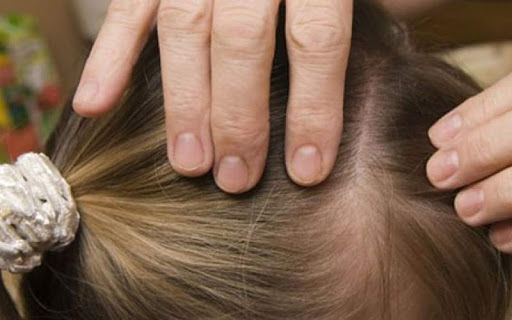 شپش و خارش سر