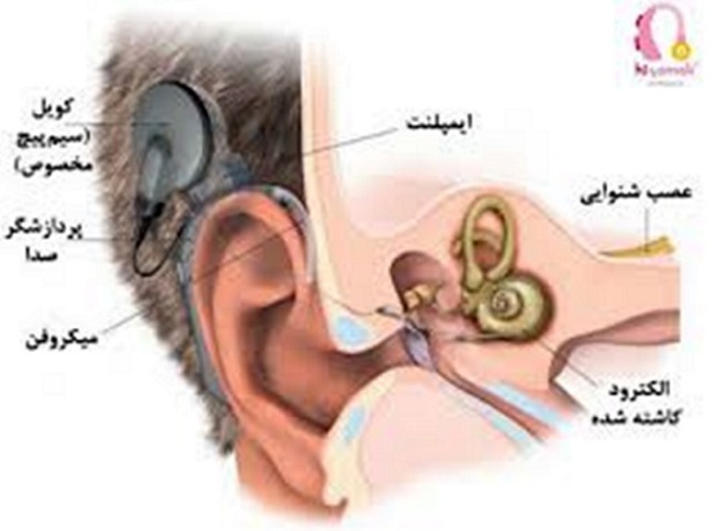 ۲۹۲ عمل کاشت حلزون شنوایی در استان همدان