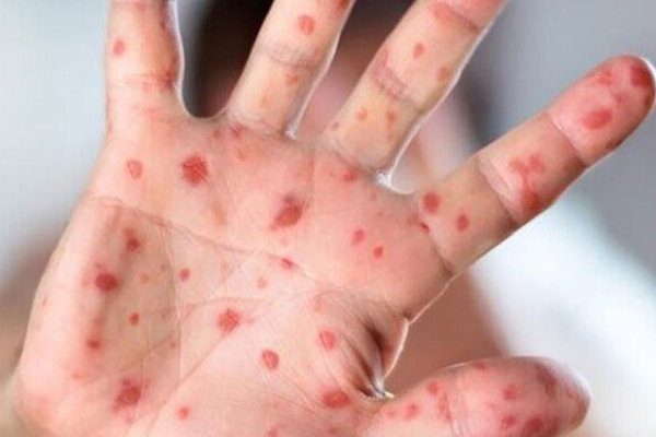 سرخک در کشور شیوع پیدا نکرده است