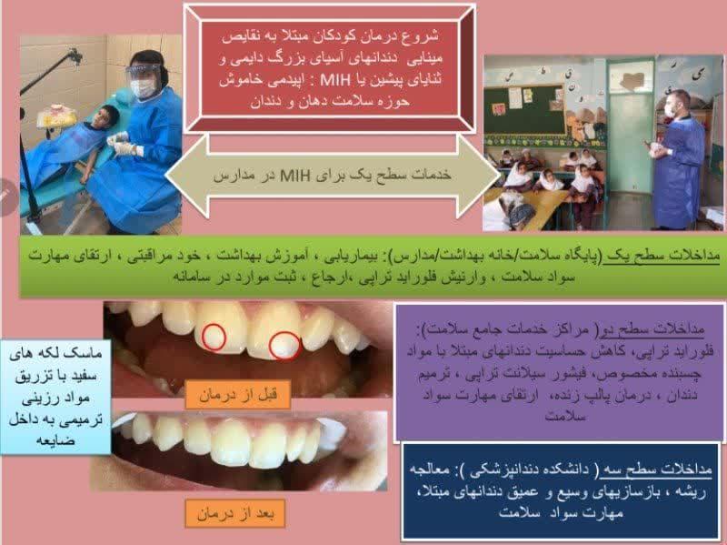 آغاز درمان کودکان مبتلا به نقایص مینایی دندان‌های مولر - ثنایا (MIH) در استان اردبیل